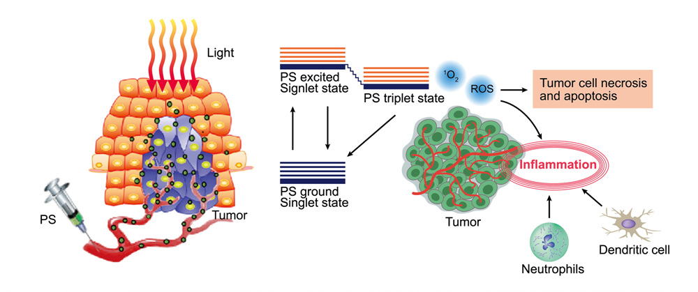 광역학치료이미지