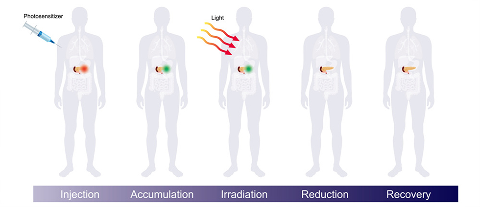 광역학치료단계이미지